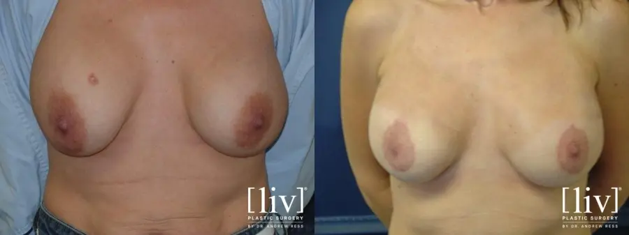Breast Lift: Patient 6 - Before and After 1