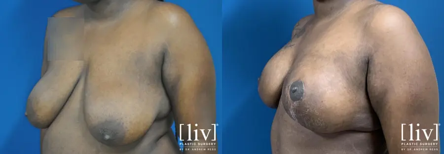 Breast Lift and Reduction - Before and After 6