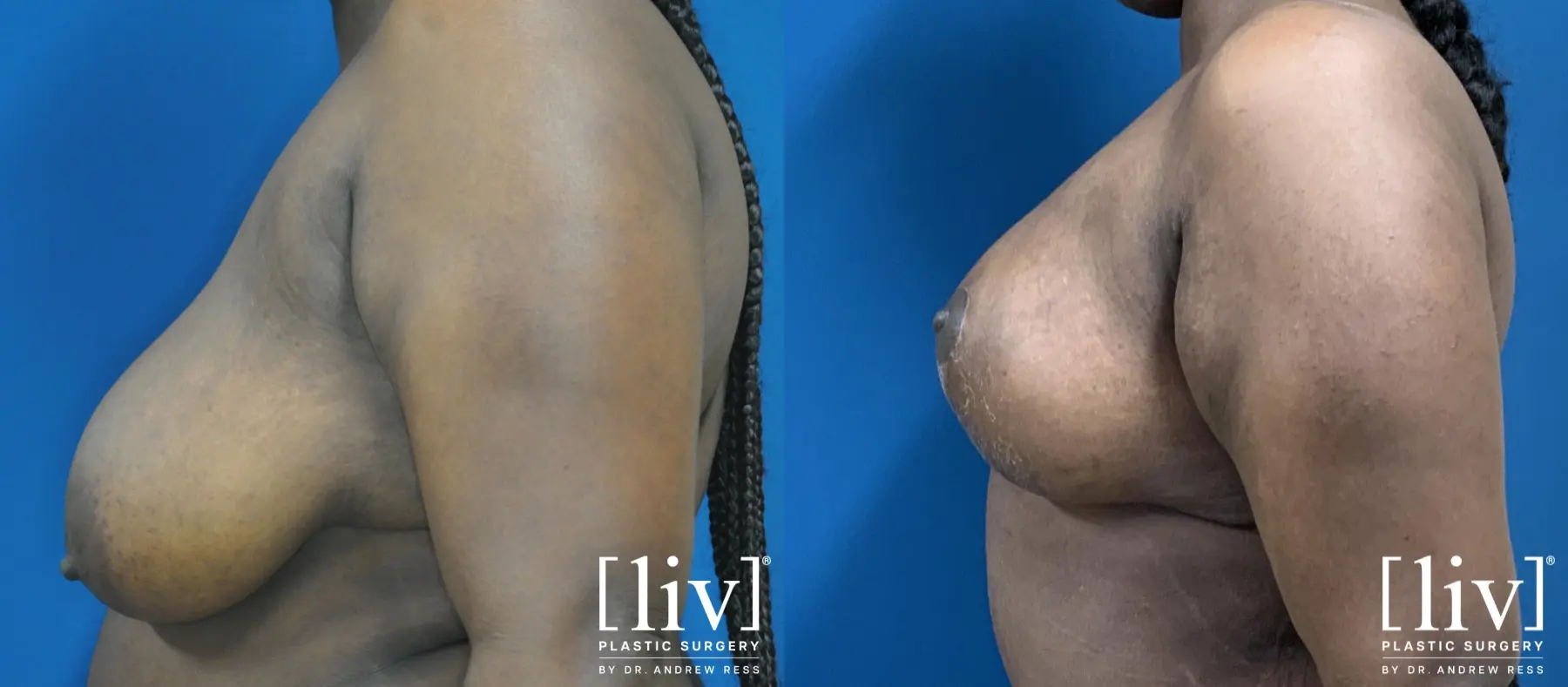 Breast Lift and Reduction - Before and After 7