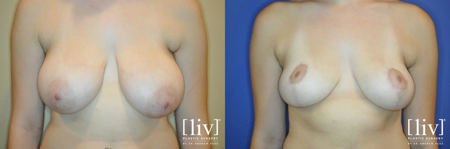 Breast Lift: Patient 2 - Before and After  