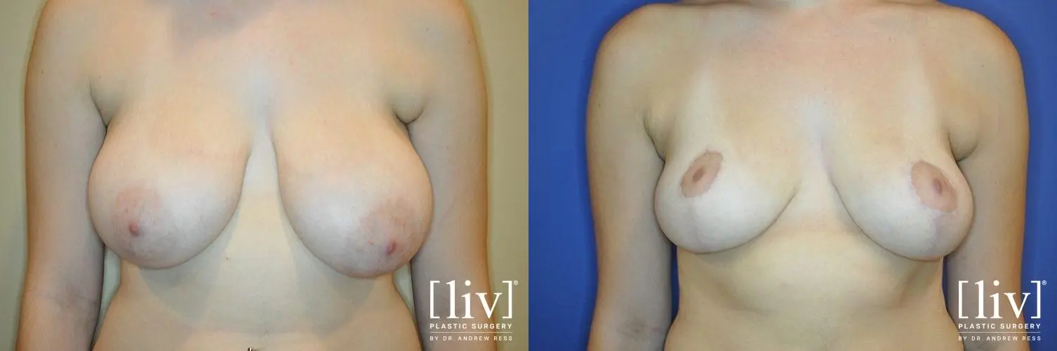 Breast Lift: Patient 2 - Before and After 1
