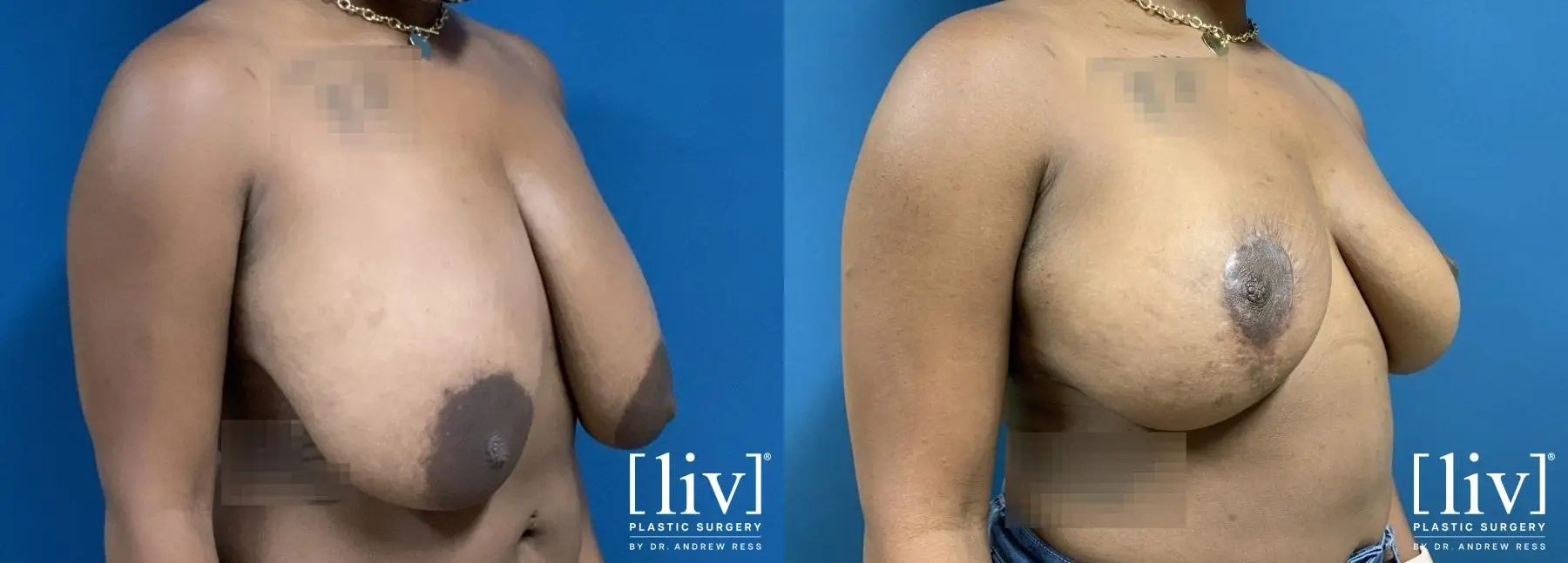 Breast Reduction: Patient 2 - Before and After 4