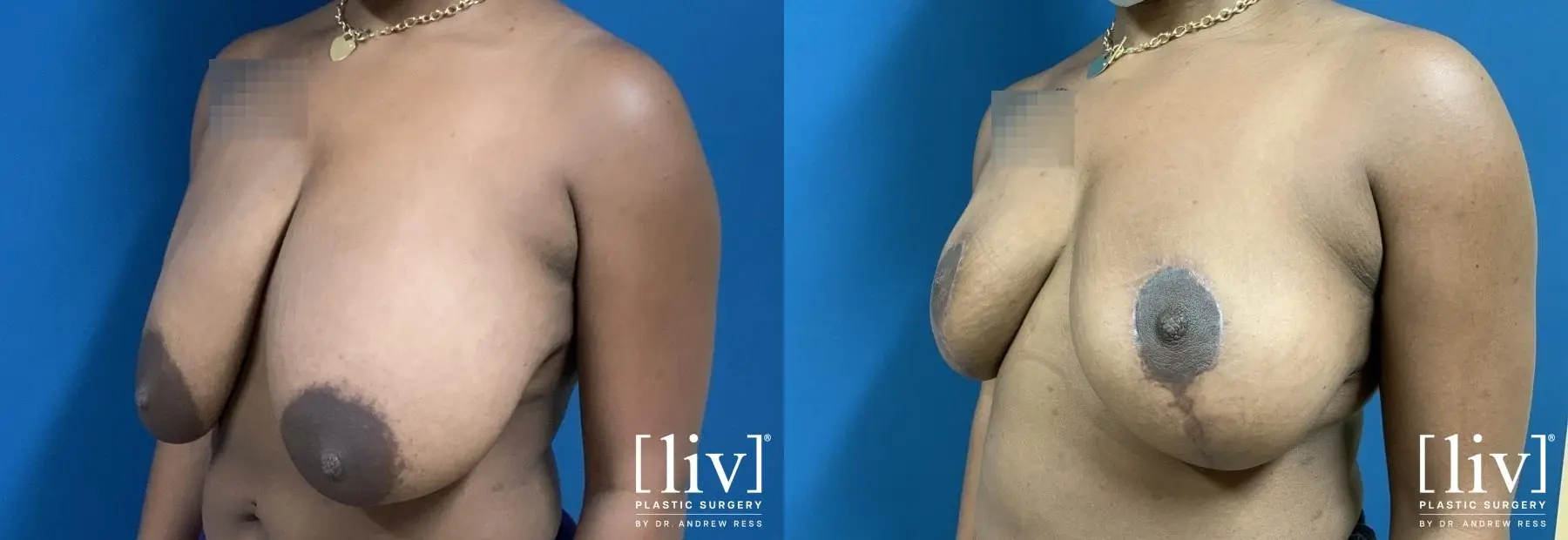 Breast Reduction: Patient 2 - Before and After 2