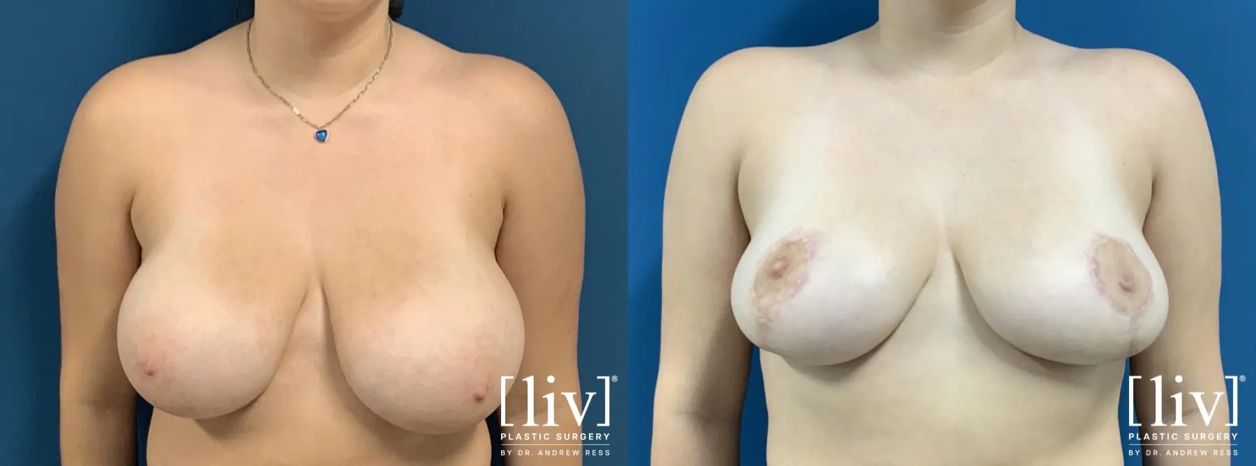 Breast Reduction: Patient 8 - Before and After 1