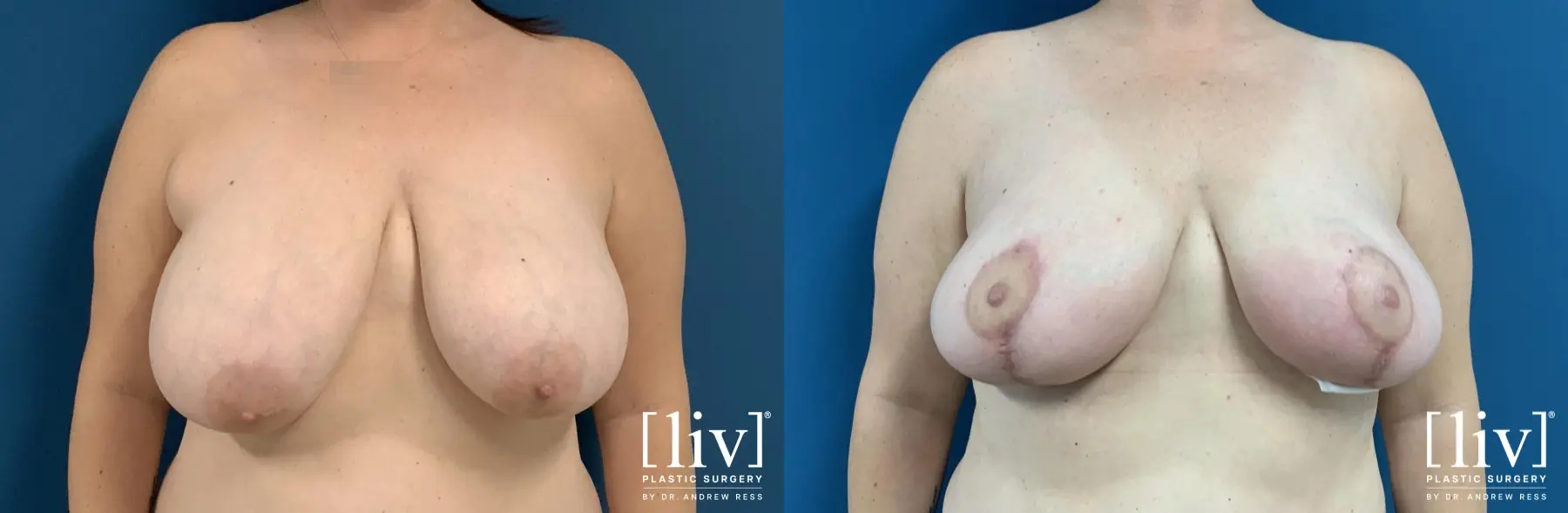 Breast Reduction: Patient 3 - Before and After 1