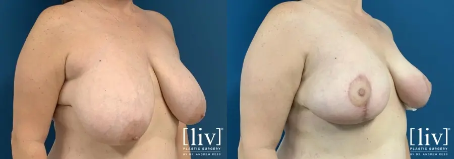 Breast Reduction: Patient 3 - Before and After 4