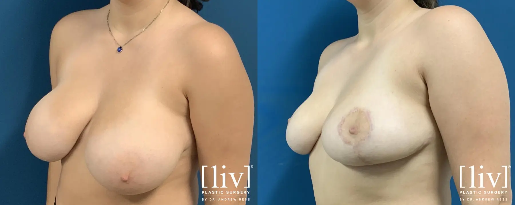 Breast Reduction: Patient 8 - Before and After 2
