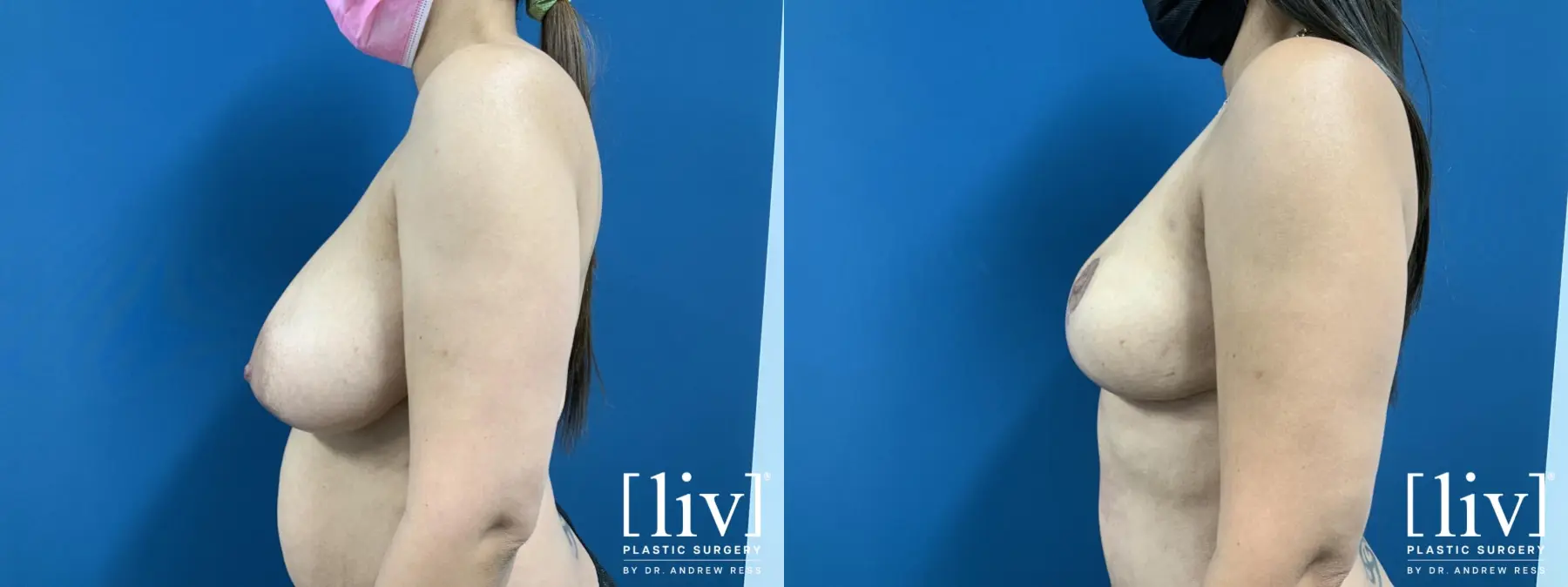 Breast Reduction - Before and After 5