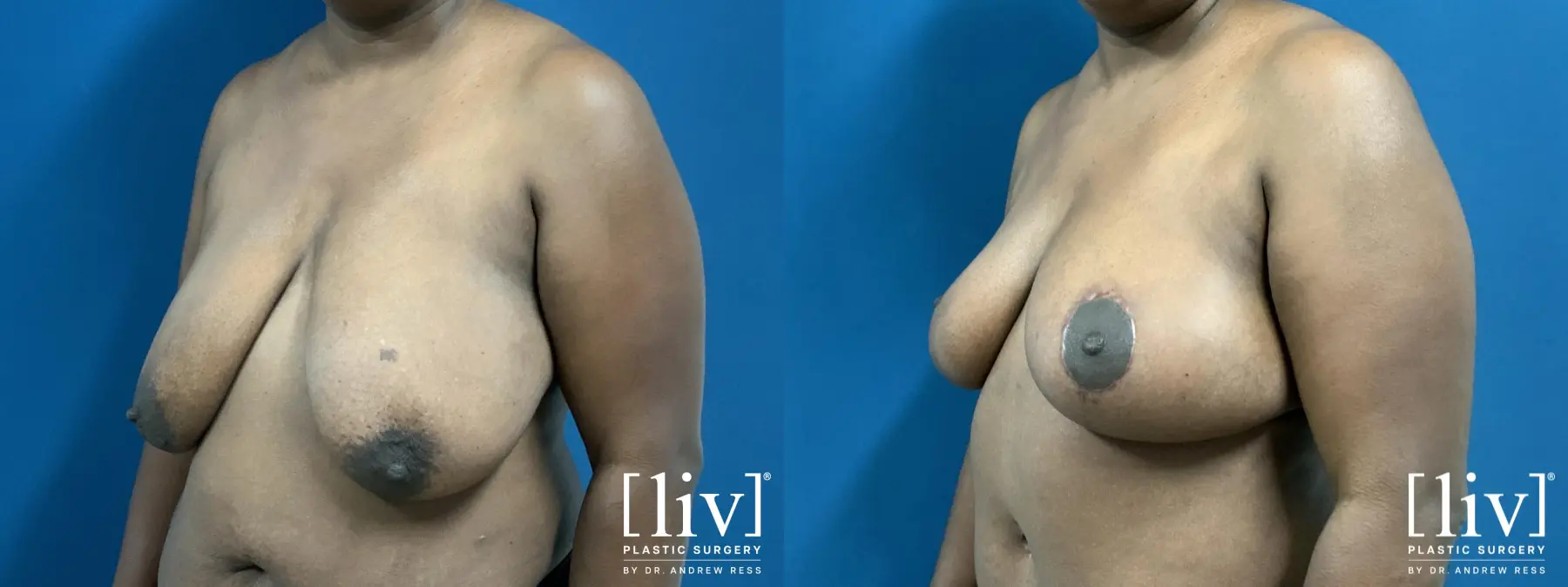 Breast Reduction: Patient 7 - Before and After 2