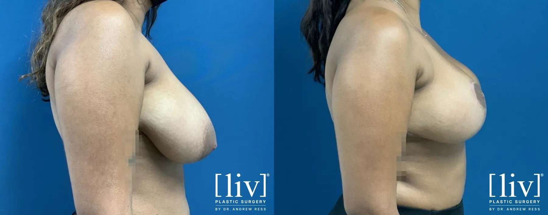 Breast Reduction: Patient 4 - Before and After 5