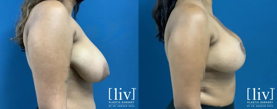 Breast Reduction: Patient 4 - Before and After 5