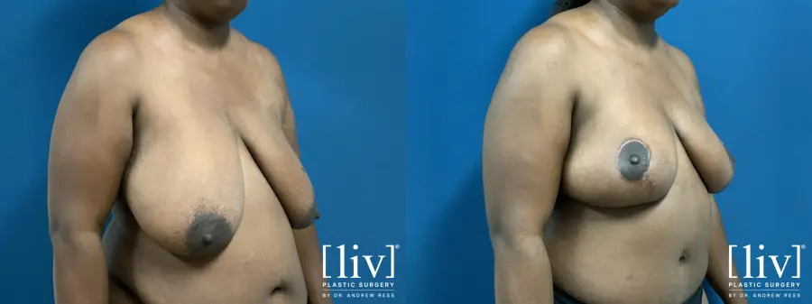 Breast Reduction: Patient 6 - Before and After 4