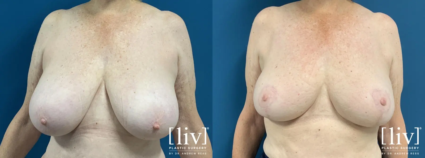Breast Reduction: Patient 6 - Before and After 1