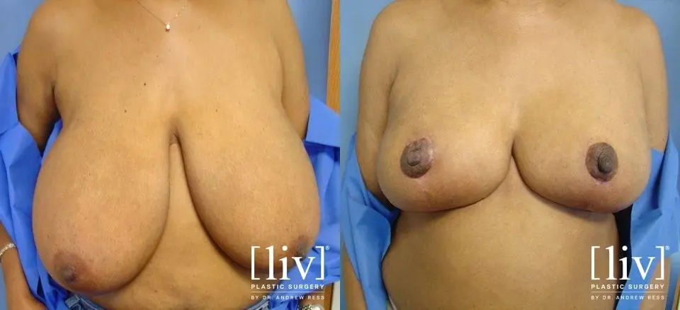 Breast Reduction: Patient 5 - Before and After 1