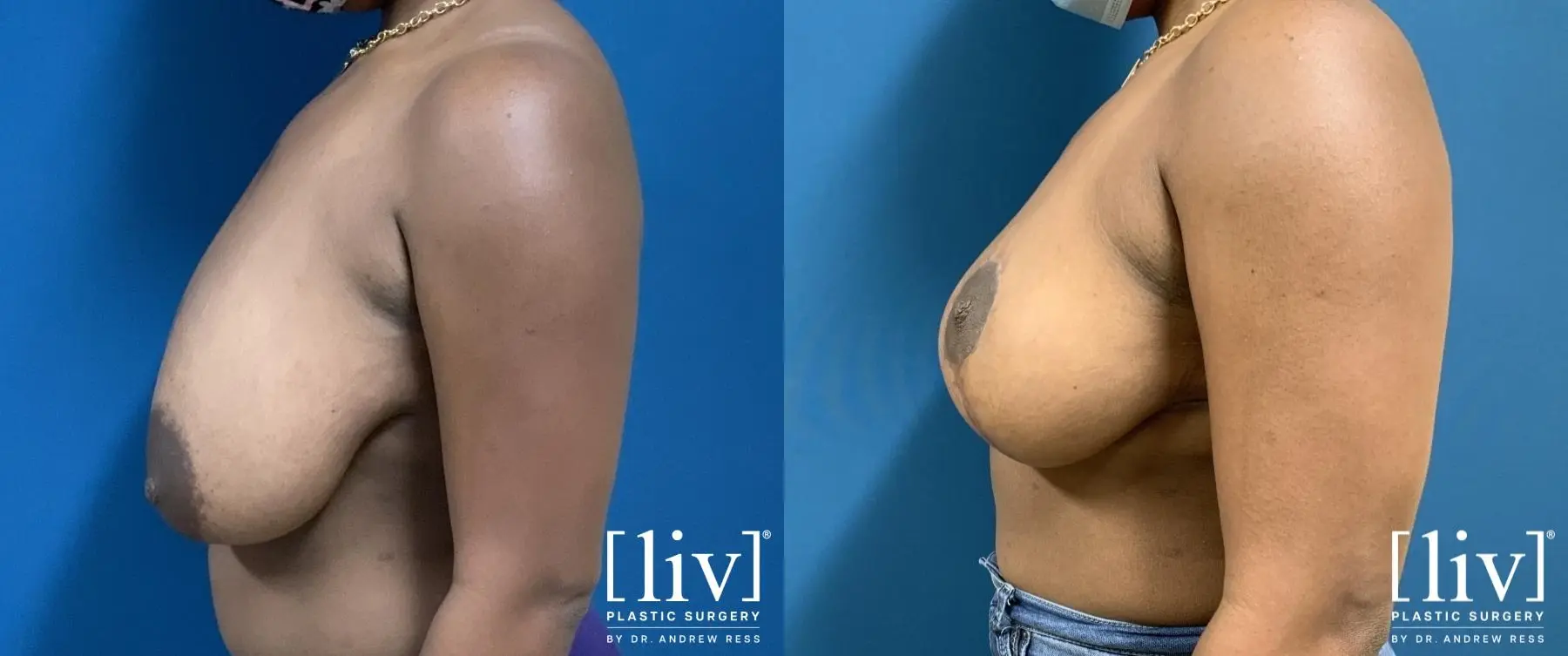 Breast Reduction: Patient 2 - Before and After 3