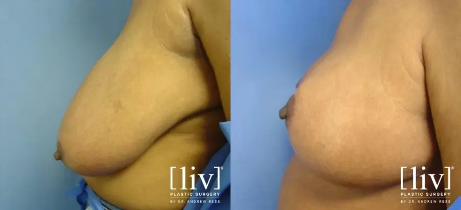 Breast Reduction: Patient 5 - Before and After 2