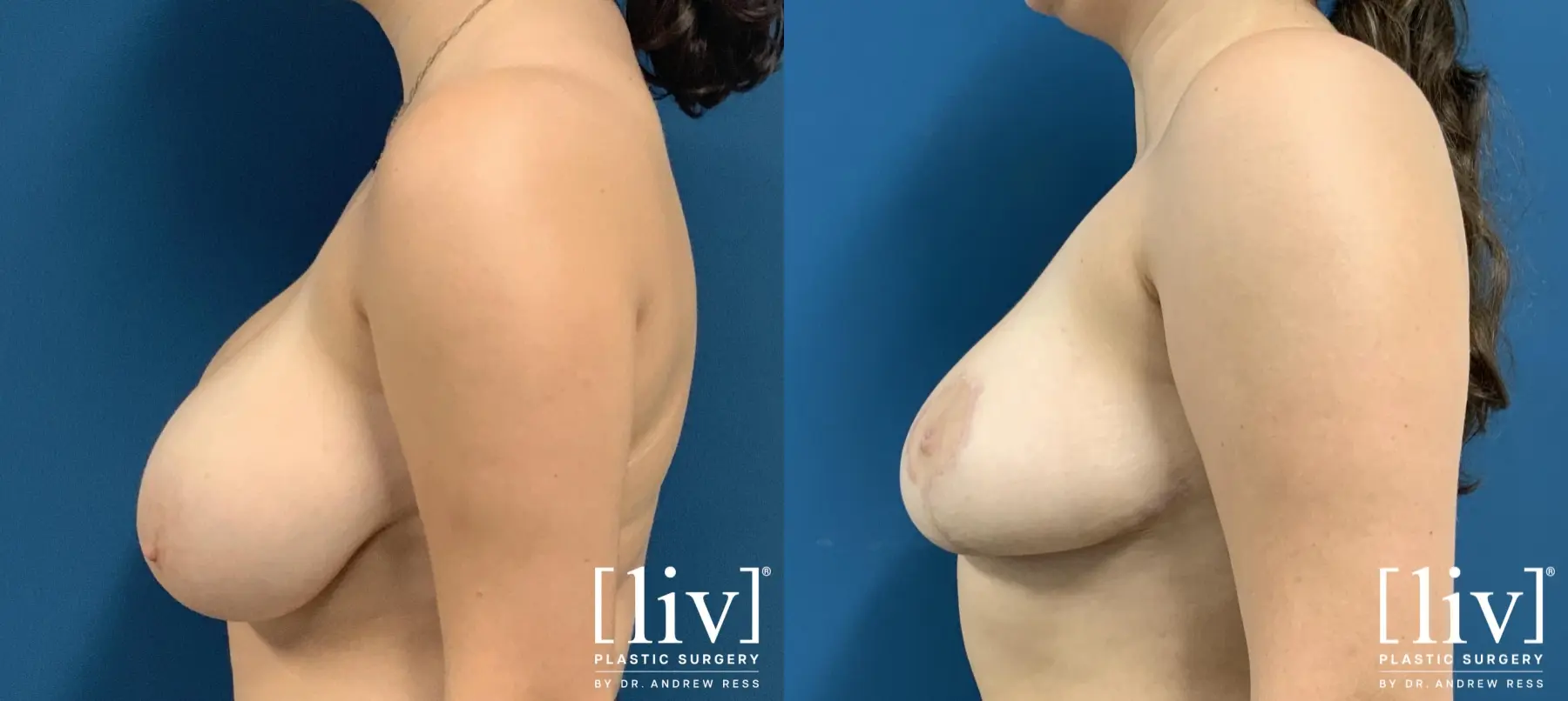 Breast Reduction: Patient 8 - Before and After 3