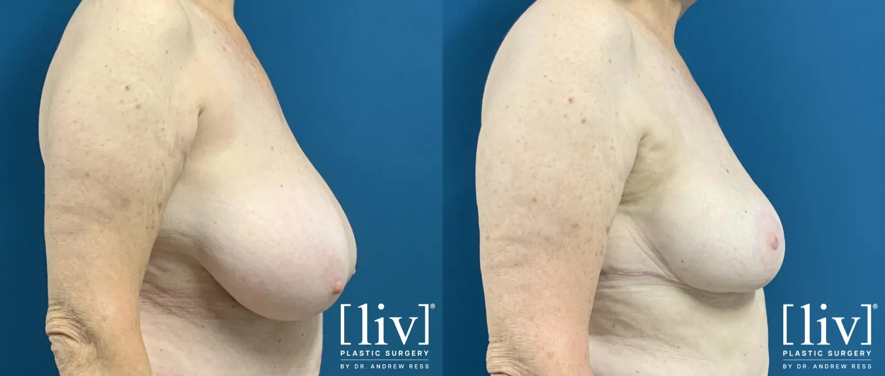 Breast Reduction: Patient 6 - Before and After 3