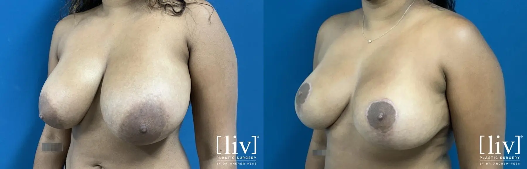 Breast Reduction: Patient 4 - Before and After 2