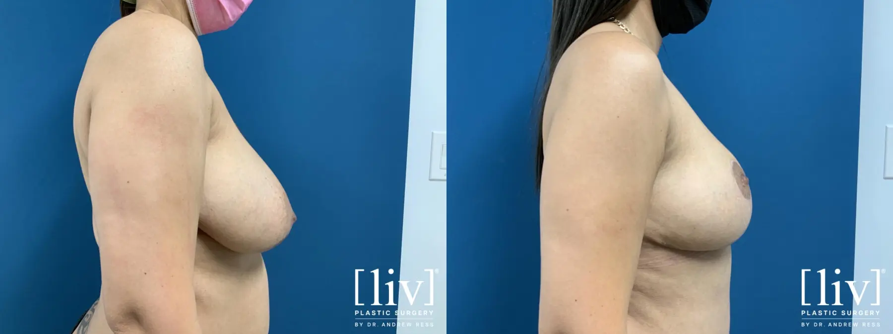 Breast Reduction - Before and After 3