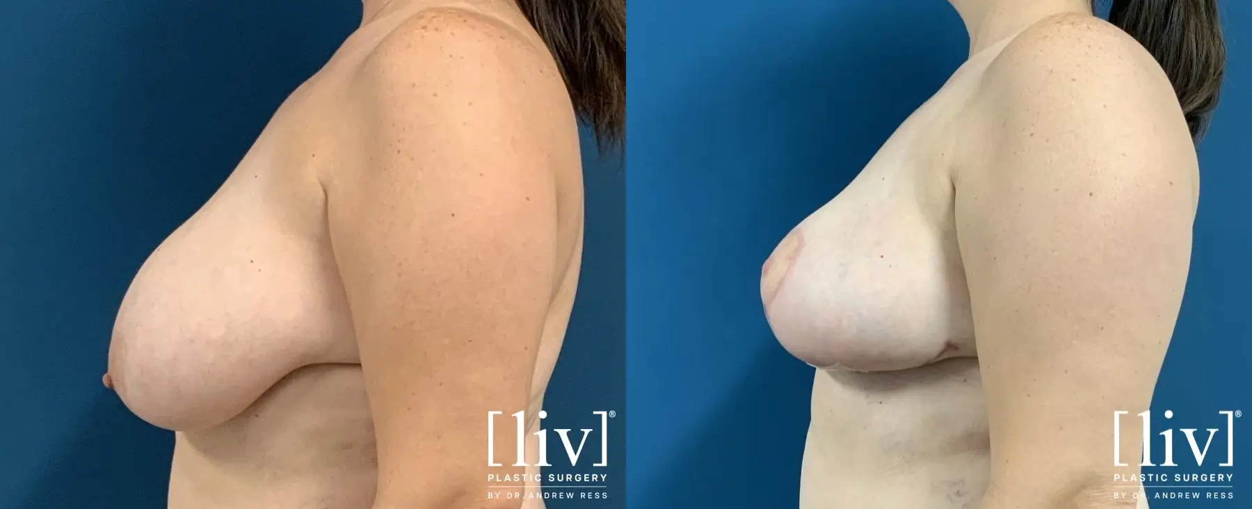 Breast Reduction: Patient 3 - Before and After 3