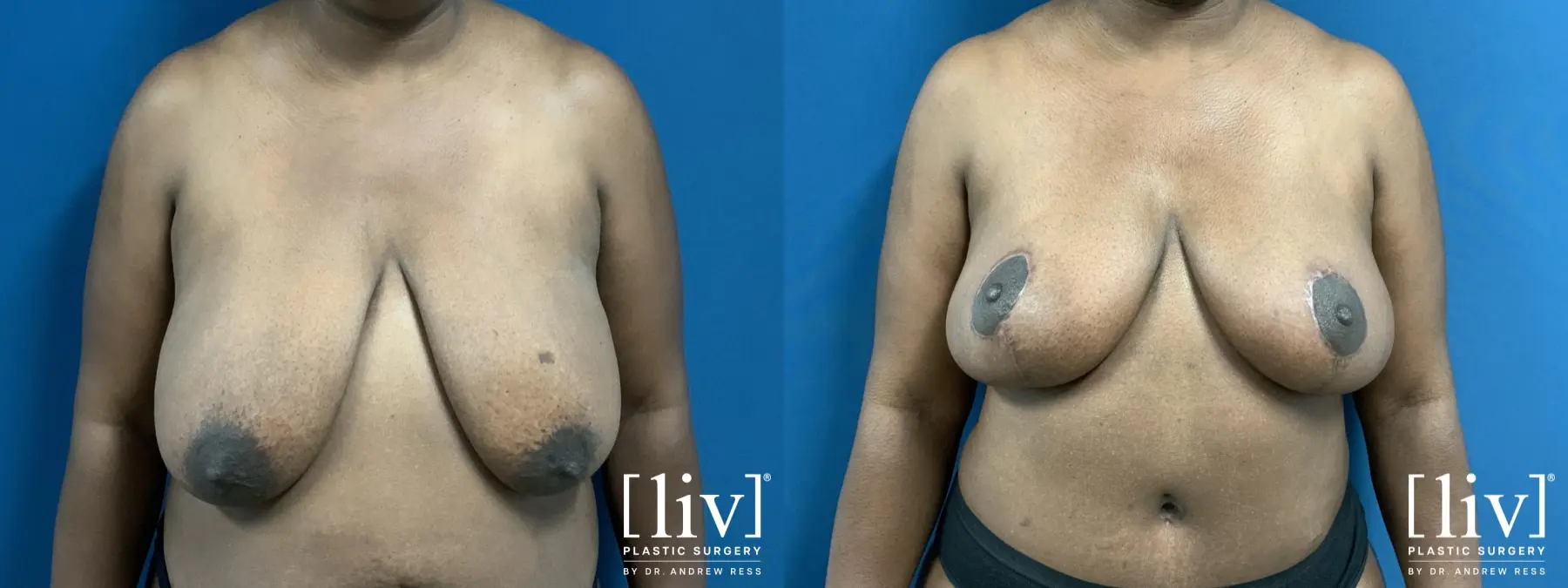 Breast Reduction: Patient 7 - Before and After 1