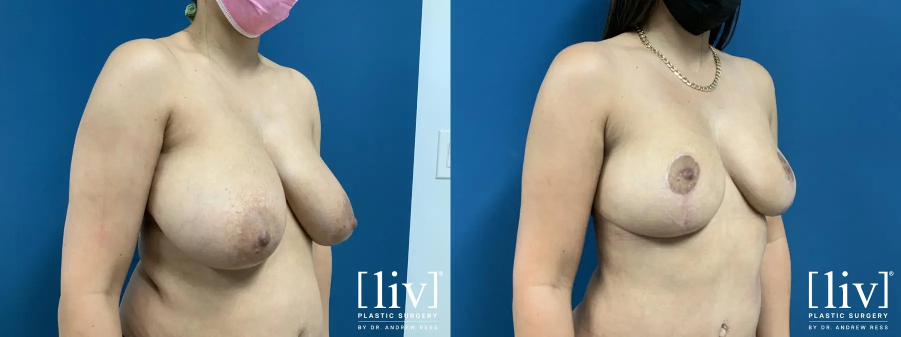 Breast Reduction - Before and After 2