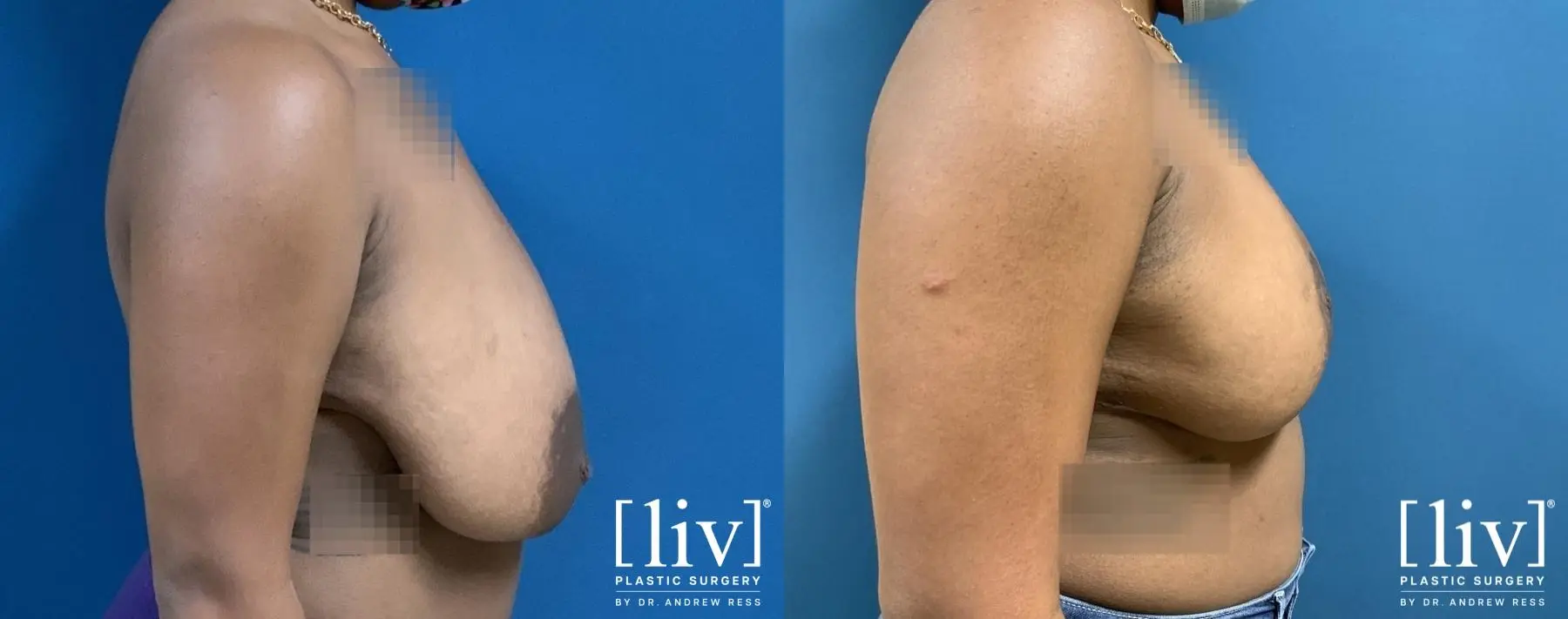 Breast Reduction: Patient 2 - Before and After 5