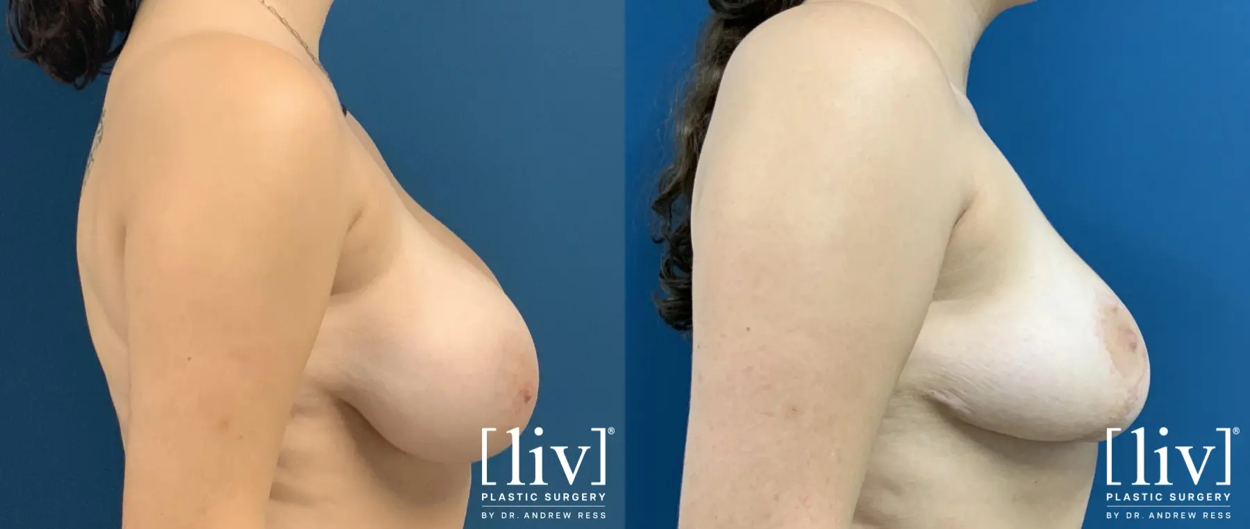Breast Reduction: Patient 8 - Before and After 5