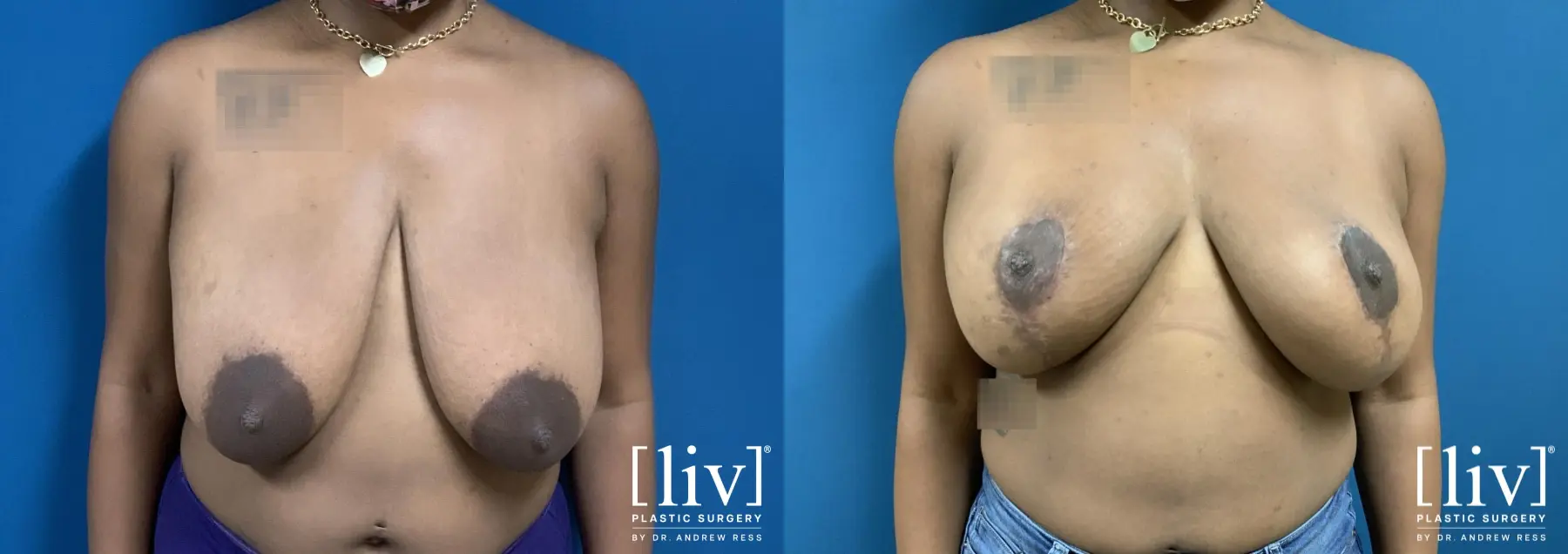Breast Reduction: Patient 2 - Before and After 1