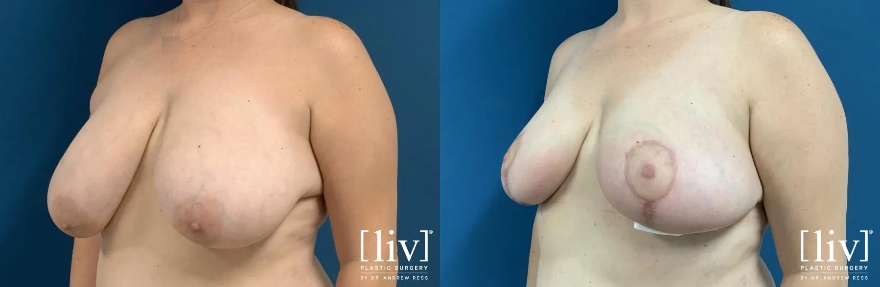 Breast Reduction: Patient 3 - Before and After 2