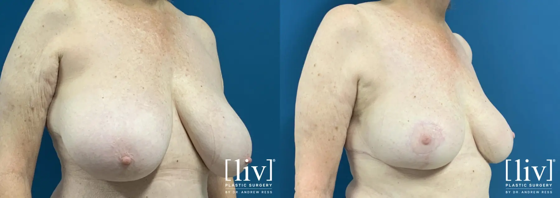 Breast Reduction: Patient 6 - Before and After 2