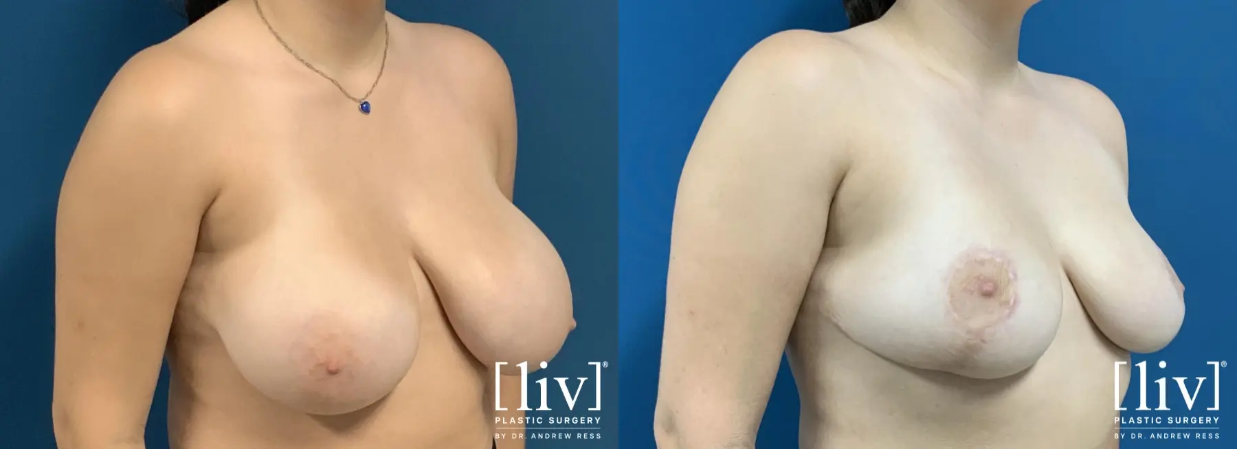 Breast Reduction: Patient 8 - Before and After 4