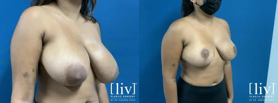 Breast Reduction: Patient 4 - Before and After 4