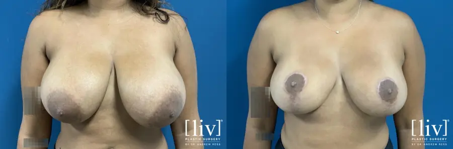 Breast Reduction: Patient 4 - Before and After  
