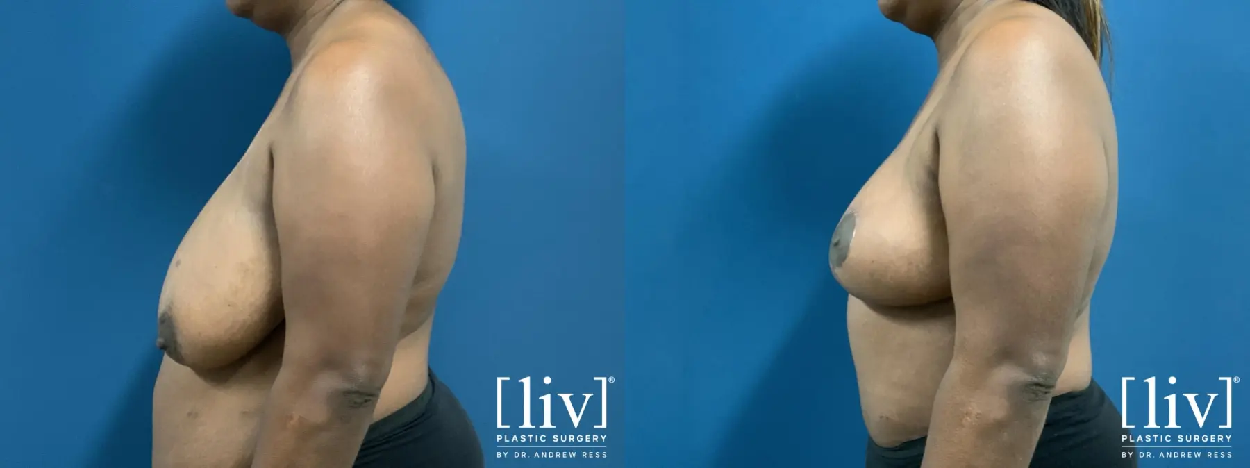 Breast Reduction: Patient 6 - Before and After 3