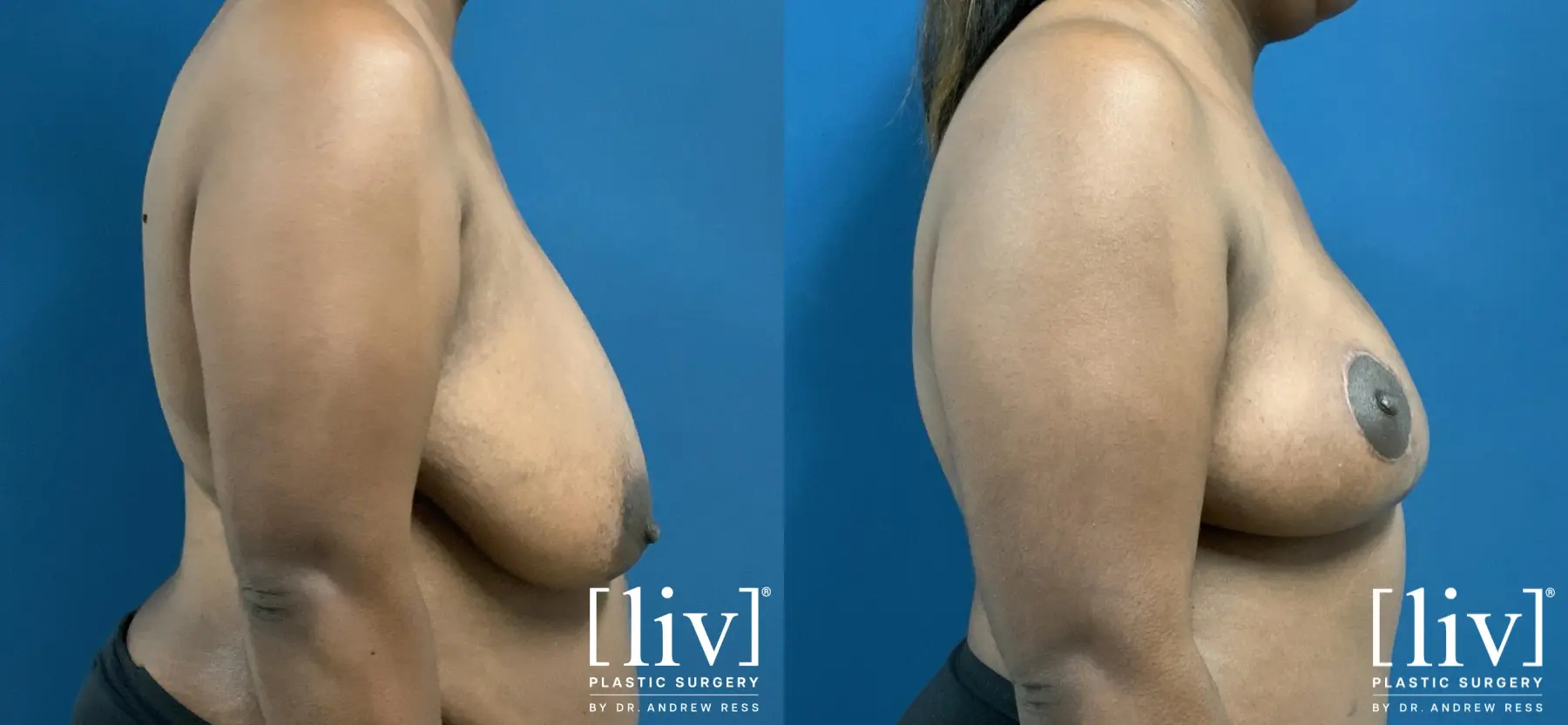 Breast Reduction: Patient 7 - Before and After 5