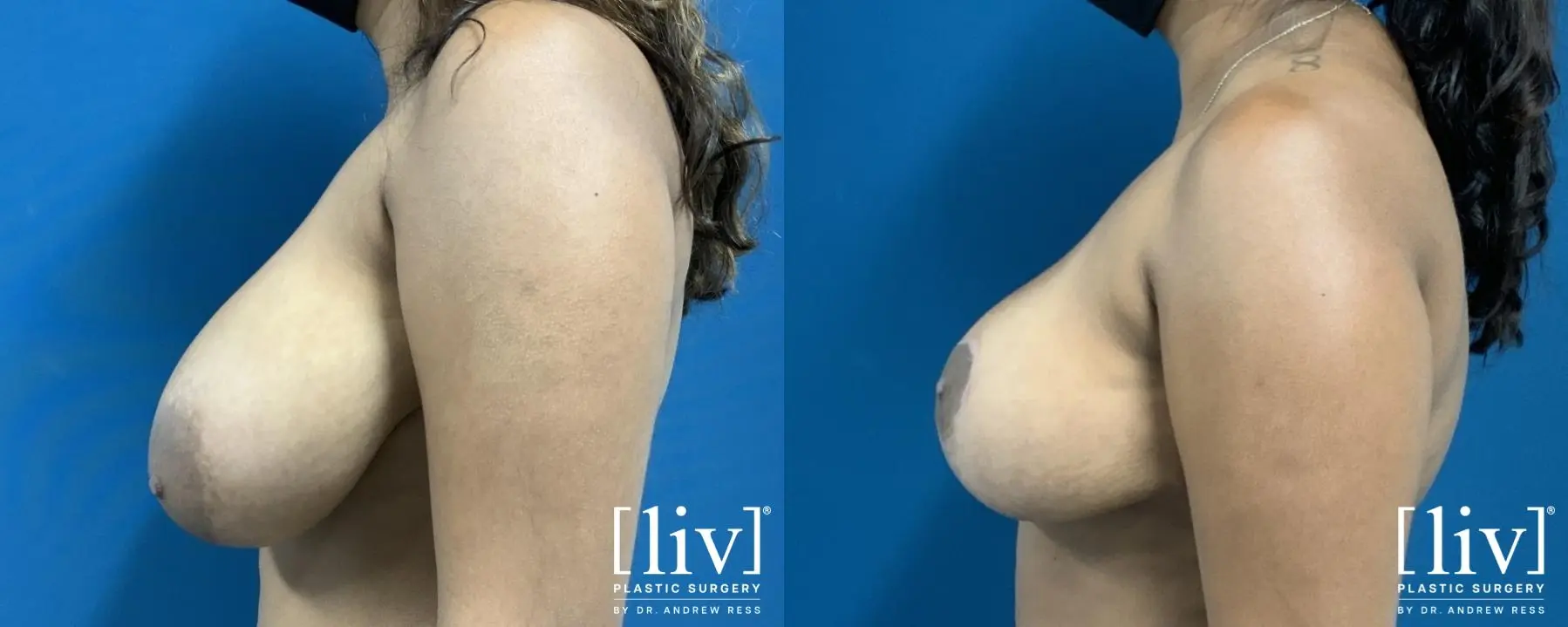 Breast Reduction: Patient 4 - Before and After 3
