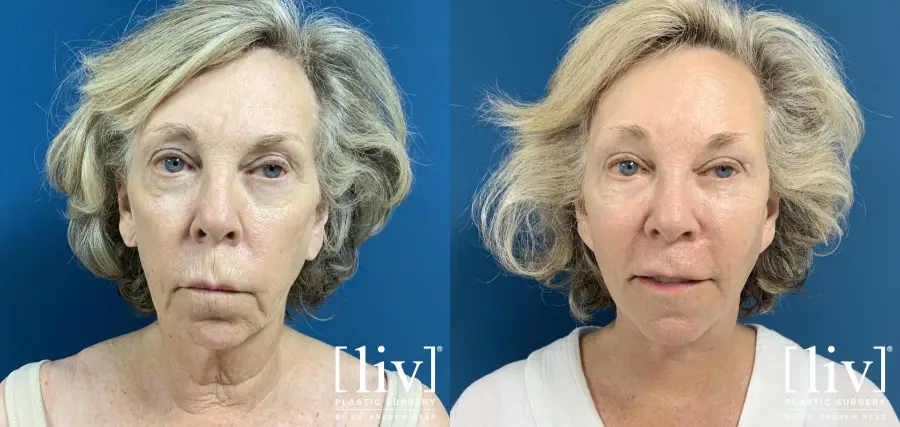 Facelift & Neck Lift with Fat Transfer - Before and After 1