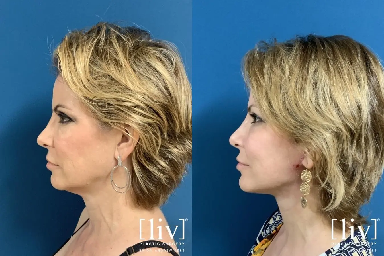 Facelift & Neck Lift: Patient 1 - Before and After 3