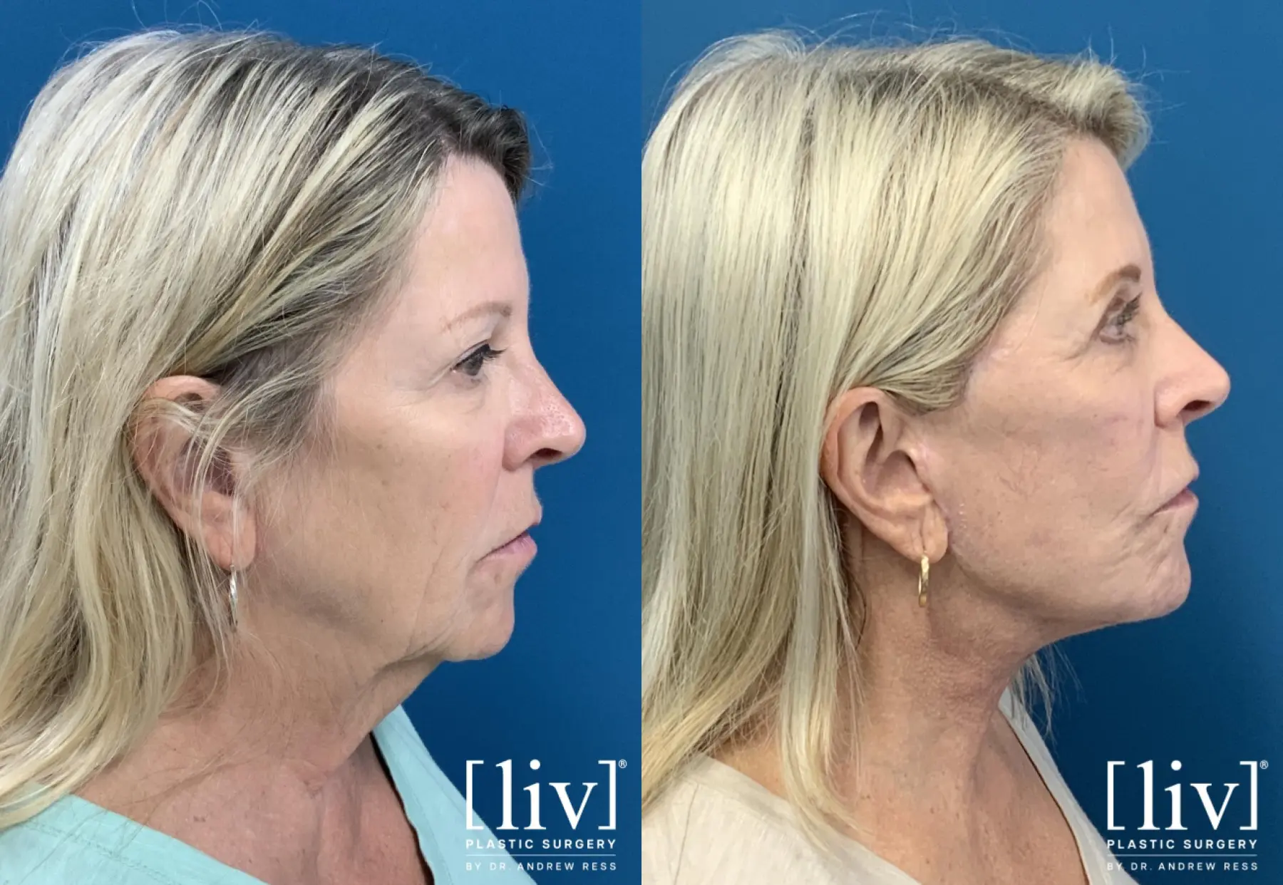 Face and Neck Lift, Co2 Laser, Fat Transfer, Upper Eyelid - Before and After 3