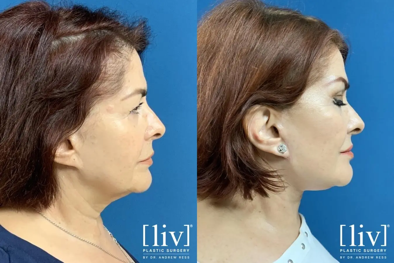 Facelift & Neck Lift: Patient 2 - Before and After 5