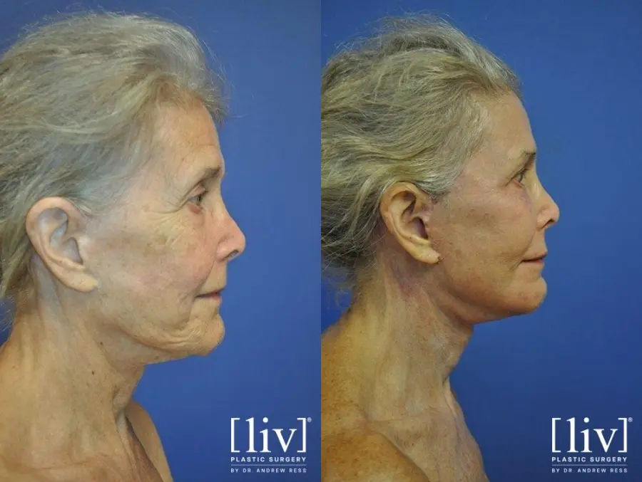 Facelift & Neck Lift: Patient 8 - Before and After 3