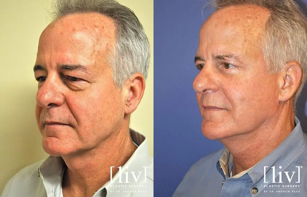 Facelift & Neck Lift: Patient 13 - Before and After 2
