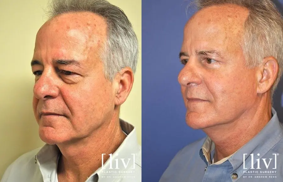 Facelift & Neck Lift: Patient 9 - Before and After 2