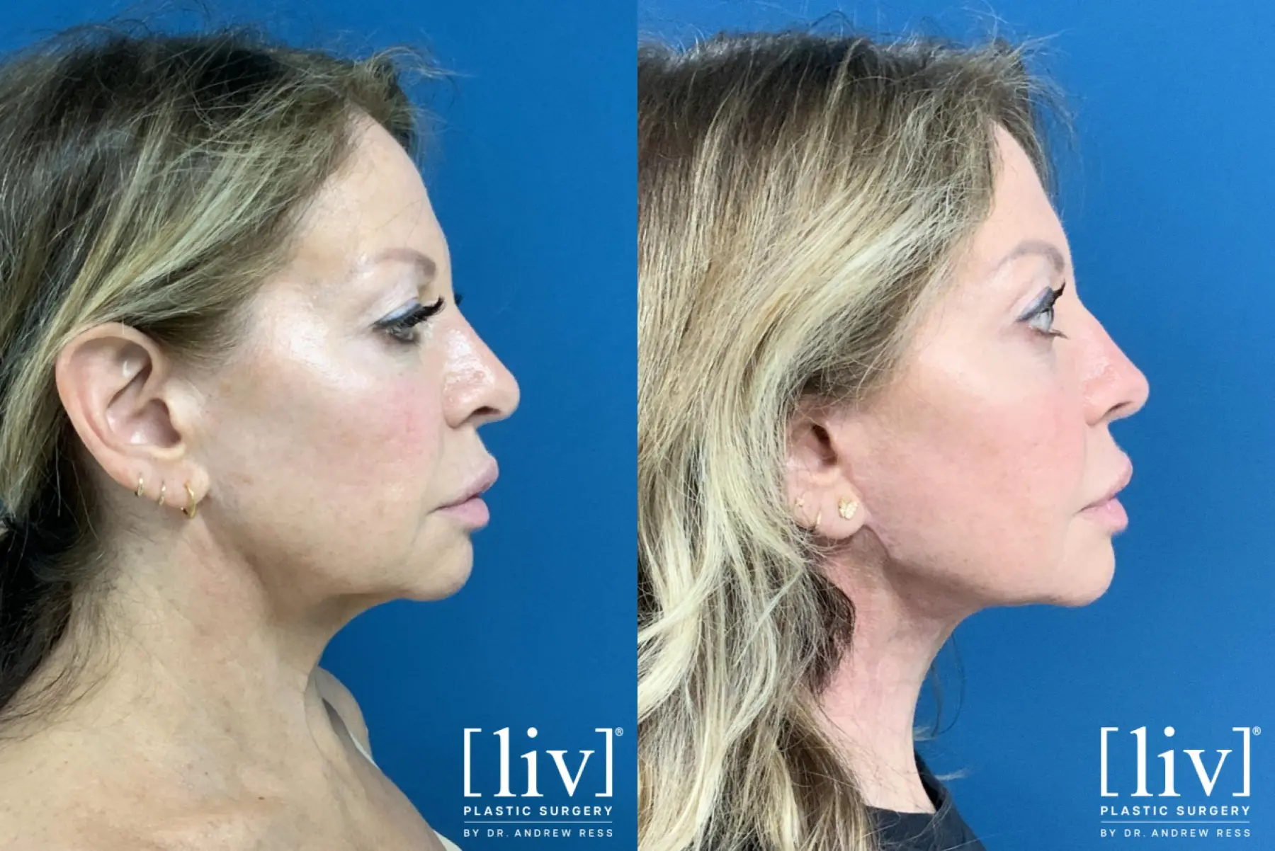 Neck Lift with CO2 Laser  - Before and After 3