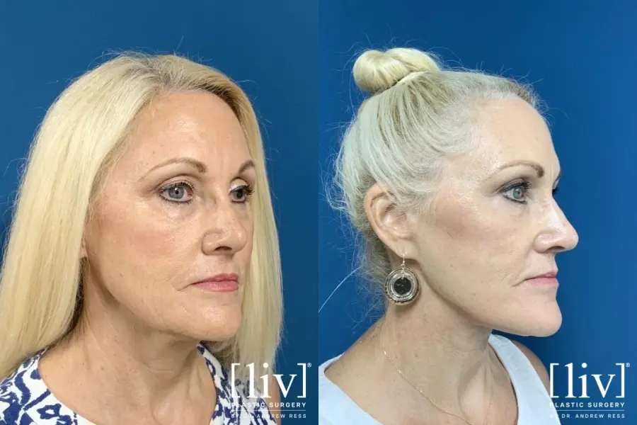 Facelift & Neck Lift: Patient 5 - Before and After 4