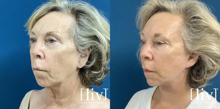 Facelift & Neck Lift with Fat Transfer - Before and After 2