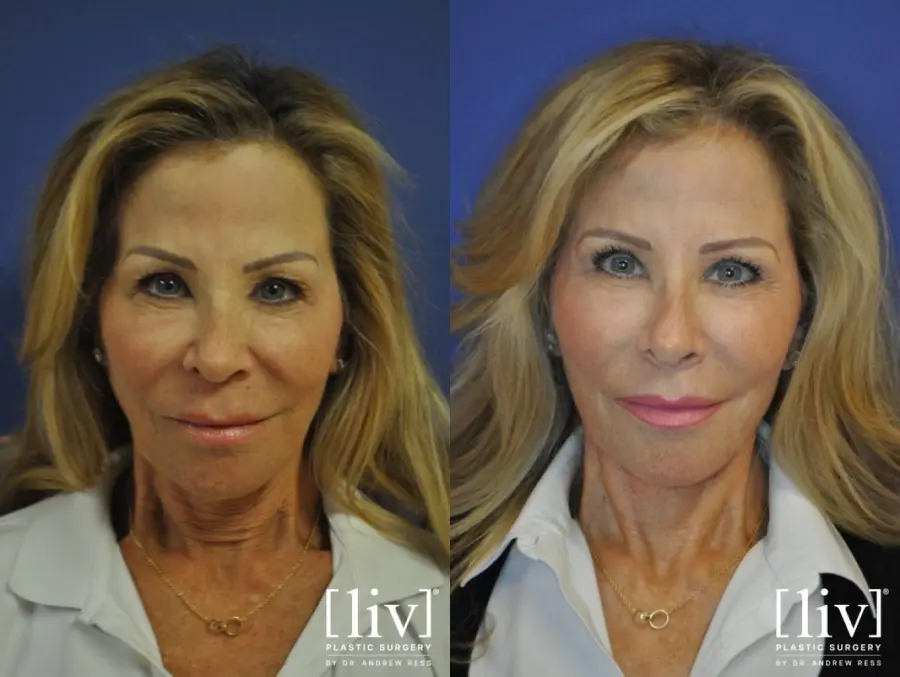 Facelift & Neck Lift: Patient 6 - Before and After  