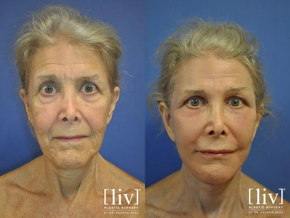Facelift & Neck Lift: Patient 12 - Before and After 1